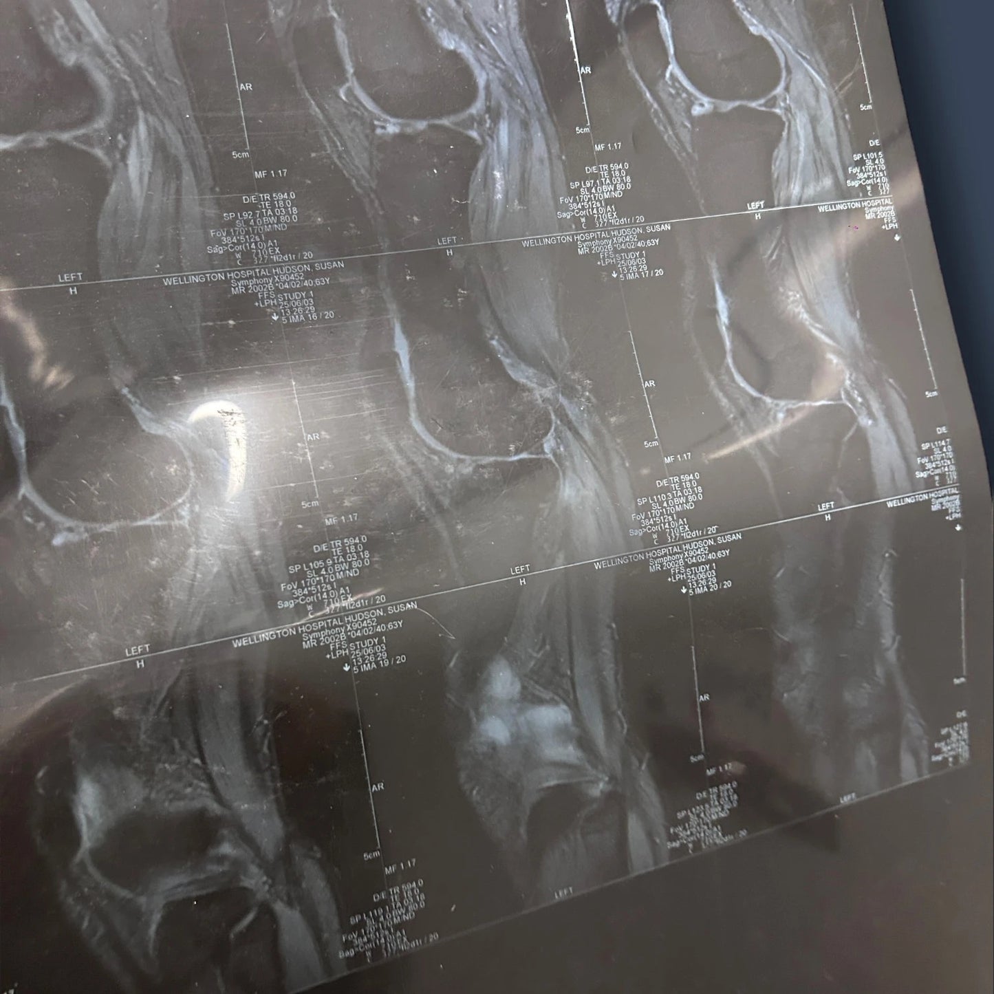 Vintage X Ray Knee Scan Acetate Film Clipping