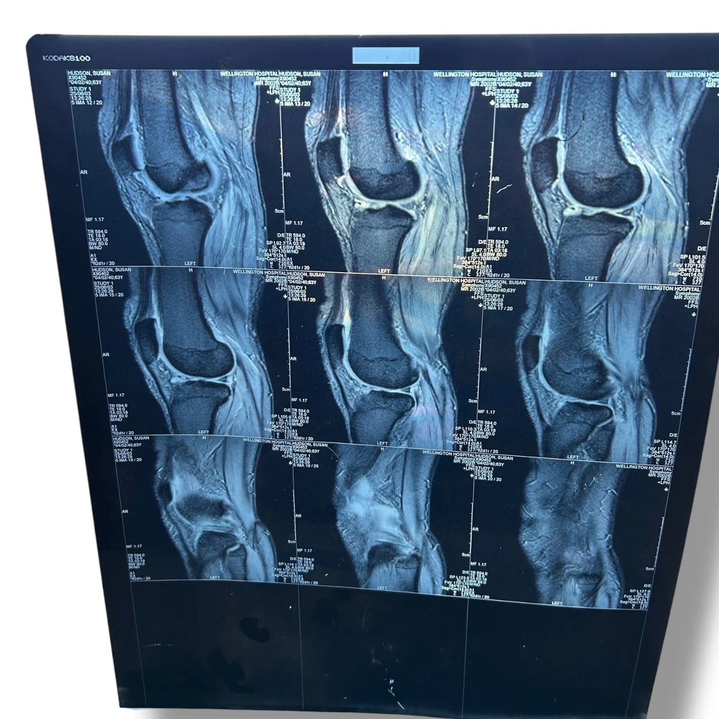 Vintage Knee X-Ray Film – Authentic Medical Imaging Print
