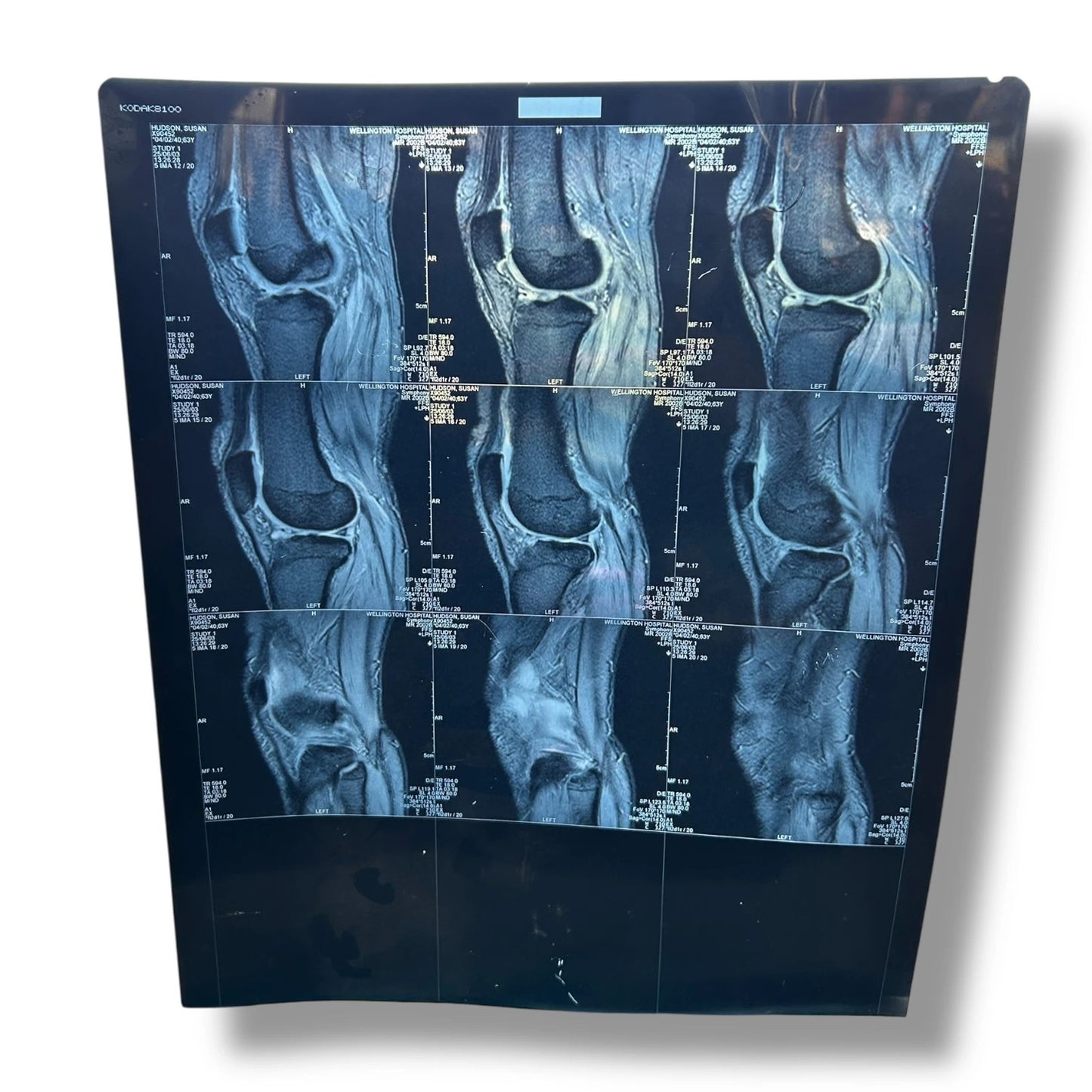 Vintage Knee X-Ray Film – Authentic Medical Imaging Print