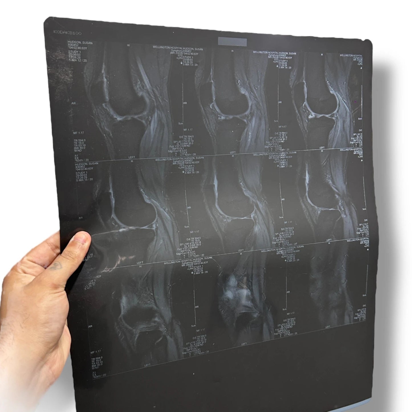 Vintage X Ray Knee Scan Acetate Film Clipping