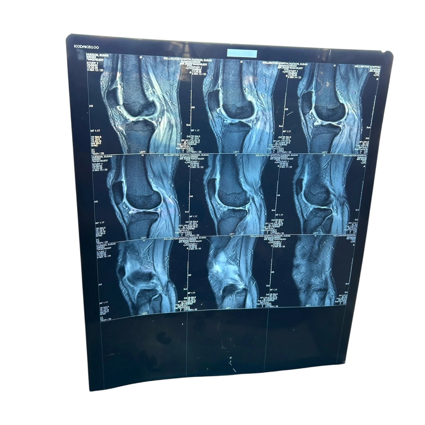 Vintage Knee X-Ray Film – Authentic Medical Imaging Print
