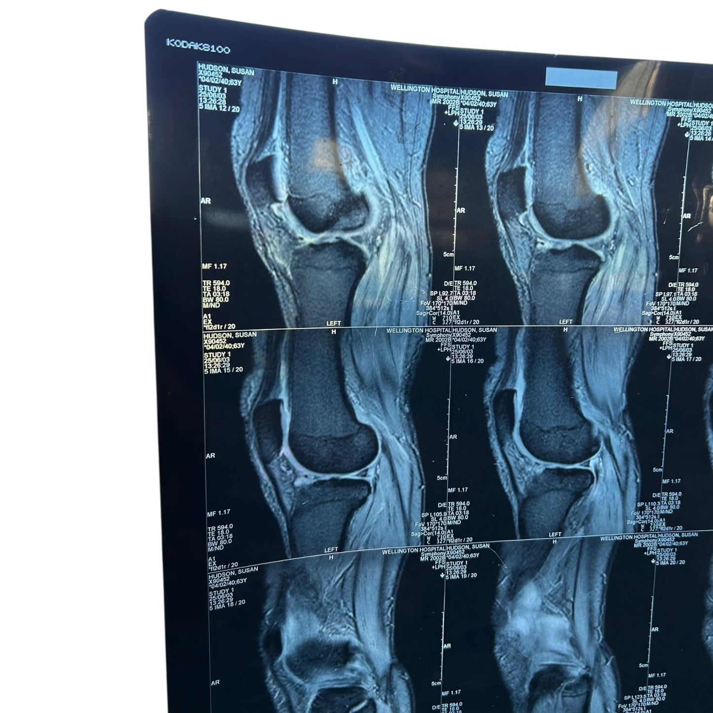 Vintage Knee X-Ray Film – Authentic Medical Imaging Print