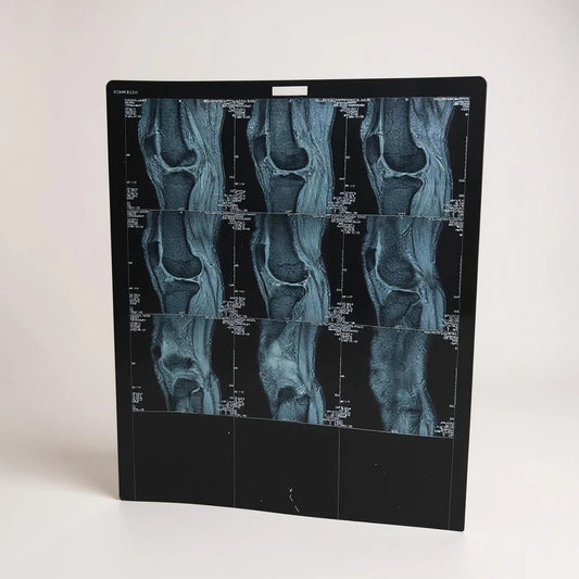 Vintage Knee X-Ray Film – Authentic Medical Imaging Print