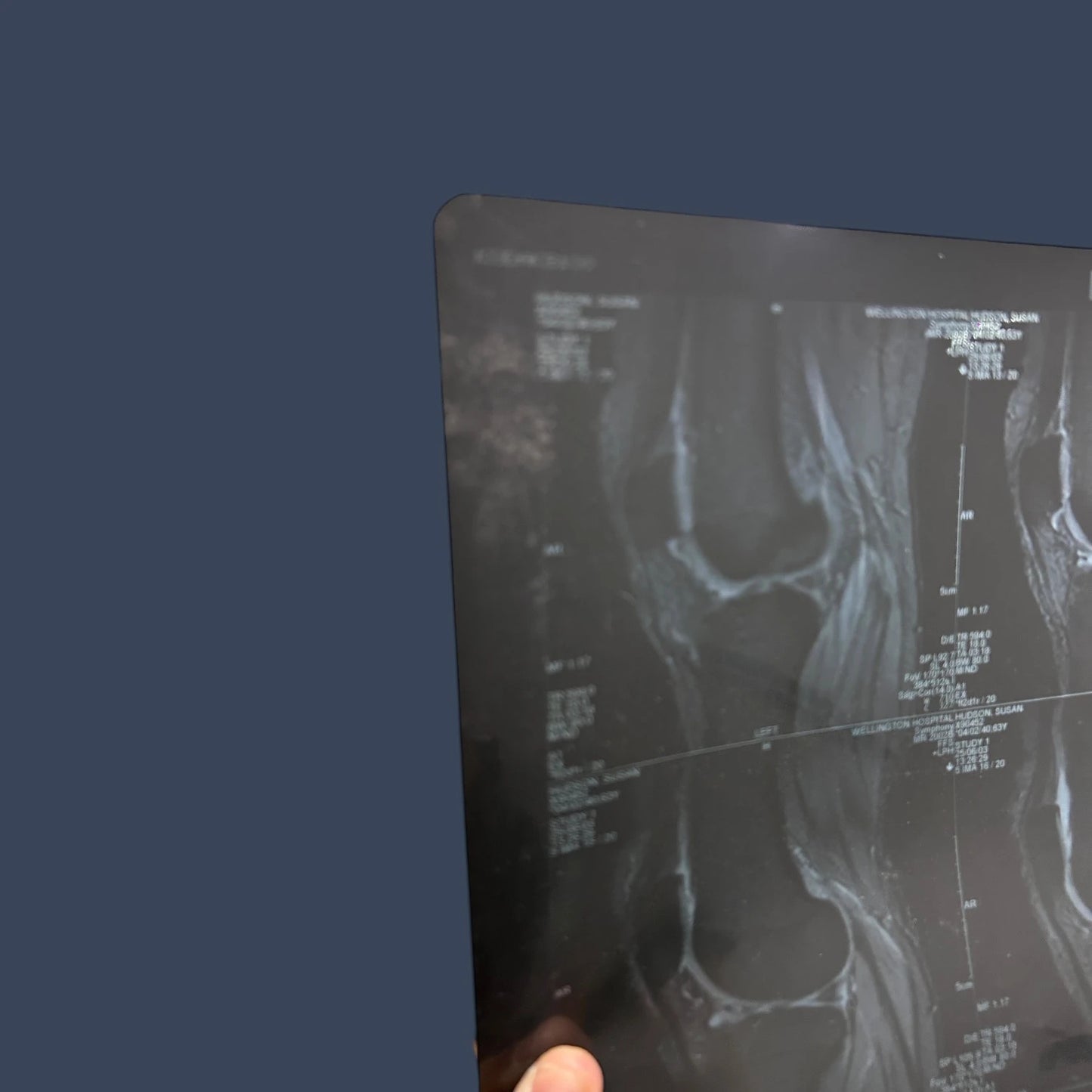 Vintage X Ray Knee Scan Acetate Film Clipping