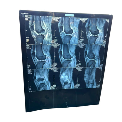 Vintage Knee X-Ray Film – Authentic Medical Imaging Print
